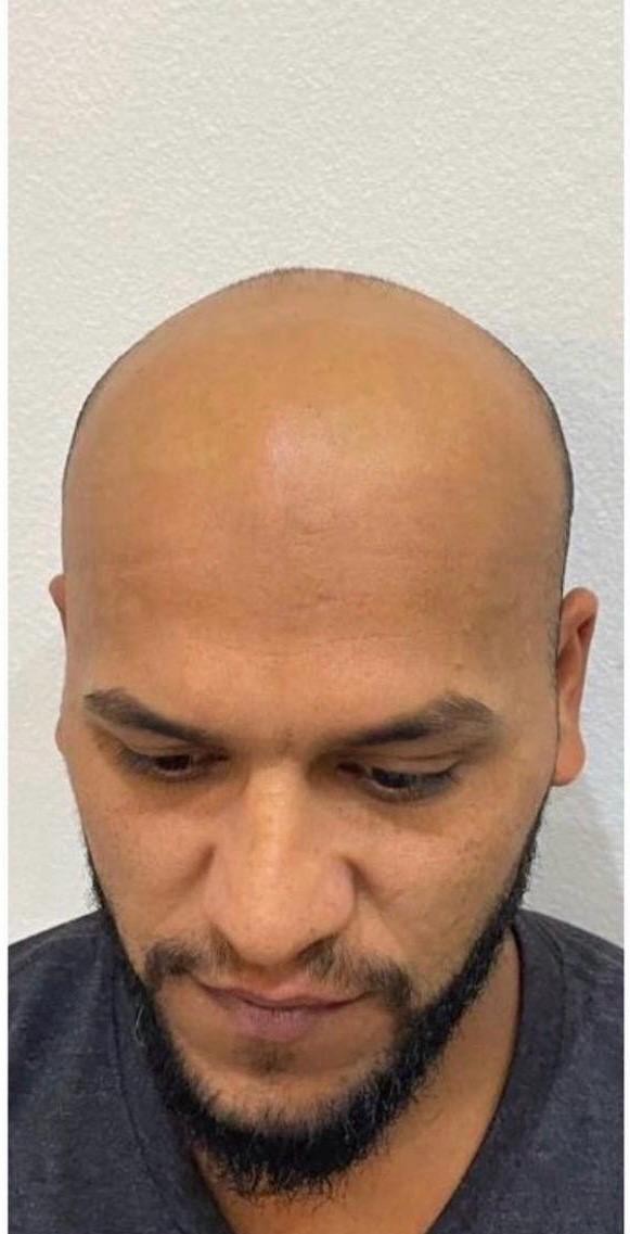 Avant technique DHI